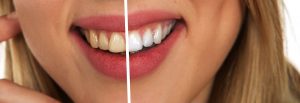 tooth-whitening-before-after